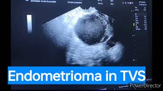 endometrioma sonography ovariancyst hydrosalpinxultrasound of ovary endometrioma endometriosis [upl. by Sahcnip600]