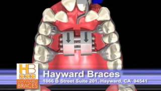 Hayward Braces OrthodonticsPalatal Expander [upl. by Jasun]