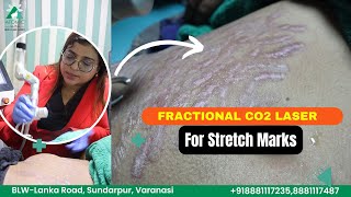 Stretch Mark in Pregnancy  Get Rid of Stretch Mark at Atomic Clinic by Dr Sneha Gupta [upl. by Anitnelav]