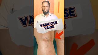 வெரிகோஸ் வெயின்ஸ் Varicose Veins youtubeshorts tamil shortsfeed [upl. by Shirleen]