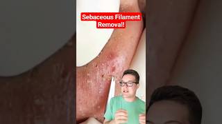 Major BLACKHEAD REMOVAL  Popping Sebaceous Filaments shorts [upl. by Faye]