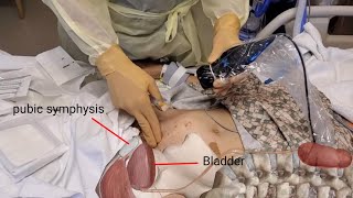 Ultrasound Guided Subrapubic Catheter [upl. by Bellaude]