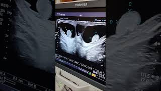 congenital hydrocelefluid in scrotal sacsnew born bady hydrocele [upl. by Ainorev426]