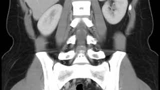 GU C7 Ovarian Torsion [upl. by Fast377]