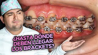 ¿HASTA QUE DIENTES LLEGAN LOS TUBOS BANDAS Y BRACKETS DE TU ORTODONCIA [upl. by Ellerad]