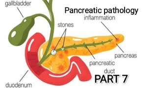 Pancreas pathology  chronic pancreatitis pathology git pancreas [upl. by Quirita]