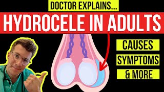 What is a HYDROCELE Doctor explains causes symptoms and treatment including surgery [upl. by Onurb419]