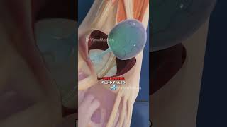 Ganglion Cyst Removal 3D Animation [upl. by Ballou]