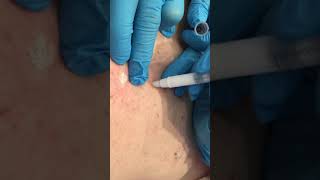 Eskata Application for Seborrheic Keratoses [upl. by Beal858]