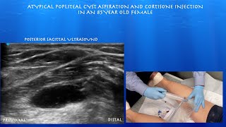 Ultrasound Guided Atypical Popliteal Cyst Aspiration and Cortisone Injection [upl. by Eugen]