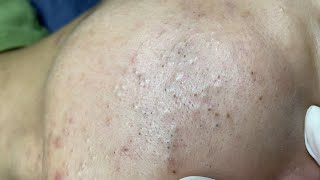 Deep Blackheads Removal from Cheeks and Nose by Na Na 24h 0012 [upl. by Ennairej]