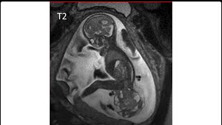 sacrococcygeal teratoma type 1 [upl. by Aldis]