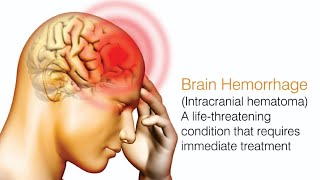 What is Brain Hemorrhage and its types l causes symptoms Treatment l [upl. by Sainana329]