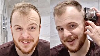 BALDING RECEDING Hairline 0 Buzz Cut Transformation At 24 [upl. by Robbyn]