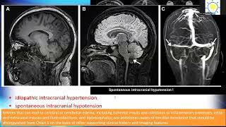 Chiari I Deformity Beyond 5 mm below the Foramen Magnum part 2 [upl. by Emilie]