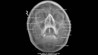 Medical Image in X ray PNS Paranasal sinus on reading paramedical medical [upl. by Anod]