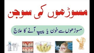 Masooron ki sujan ka ilaj  Pyorrhea treatment at home Urdu  Pyorrhoea ka gharelu ilaj [upl. by Terra]