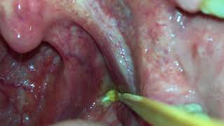 Tonsil Stone Removal By Yourself [upl. by Rufus757]