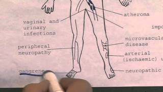 Long term complications of diabetes [upl. by Neelhtakyram]