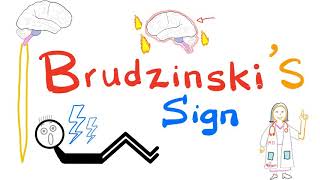 Brudzinskis Sign  Meningitis  Neurology  Physical Exam [upl. by Maroj]