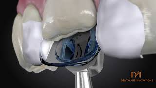 PaladexDental silicon templates for the palatal surface [upl. by Tullusus361]