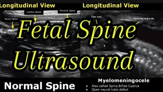 Fetal Spine Ultrasound Normal Vs Abnormal Images Appearances  Spinal Abnormalities  Obstetrics USG [upl. by Melmon]