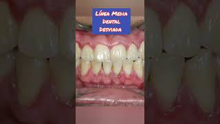 Desviación de línea media dental brackets [upl. by Eugaet985]