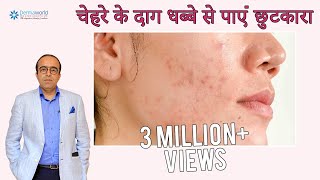 चेहरे के दाग धब्बे  पिम्पल के निशान हटाने के उपाय  Remove pimple Spots  Dr Rohit Batra [upl. by Enitsyrhc]