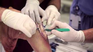 Patellar Tendon Graft [upl. by Plusch]