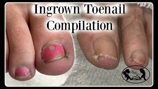 Satisfying Ingrown Toenail Pedicure Compilation [upl. by Etsirk599]