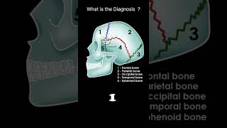 Skull bones and sutures  lateral viewCT Brain Anatomy Skull bones Quiz 3radiologychannel007 [upl. by Burnaby]