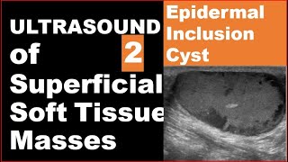 Epidermoid inclusion cyst on Ultrasound [upl. by Evonne770]