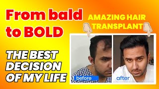 Unbelievable Hair Transplant Result 2024  Best Hair Transplant in Delhi 2024  MedLinks [upl. by Christianna291]