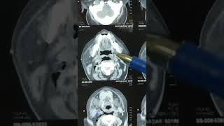 Clinical Case  Retropharyngeal Abscess [upl. by Marlette875]