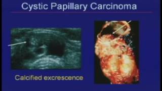 Thyroid Nodules Sonographic Evaluation and Biopsy Recommendations [upl. by Secnirp459]