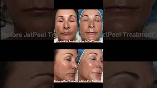 Watch a JetPeel Facial from our Medical Aesthetician Farzaneh Momeni [upl. by Cindee]