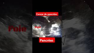 Échographie abdominale cancer pancréas processus tumorale corporeocaudale du pancréas pancréas [upl. by Ennaisoj962]