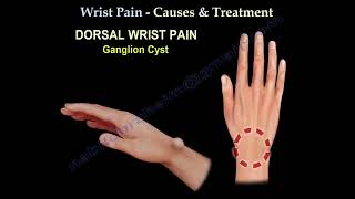 Wrist Pain causes and treatment [upl. by Cross]