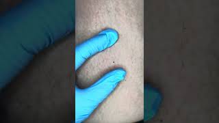 Watch Electrolysis Now Zap Hairs with Me [upl. by Aviva]