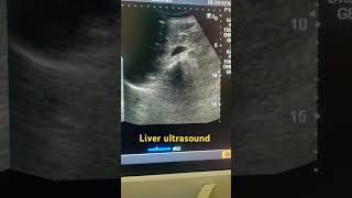 Liver ultrasound ultrasound shortfeed liver medical study ytviral education shortsviral yt [upl. by Aya410]