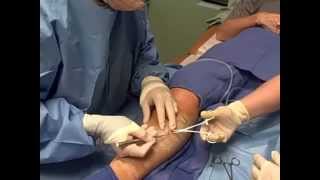 Ambulatory Phlebectomy Vein Removal  Skinovative and Center for Venous Disease [upl. by Johannessen]