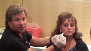 Dermal Filler Training  Nasolabial folds Injections  Empire Medical Training [upl. by Assyli]