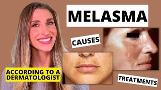 Best Melasma Treatment Dermatologist Explains Melasma Causes At Home Treatments amp More [upl. by Gabrila]