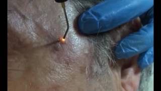 Plasmage  Treatment Fibroma Lentigo [upl. by Mokas822]