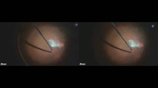 Vitrectomie 27G 3D  traction vitreomaculaire 27G vitrectomy  VMT [upl. by Llehcar]