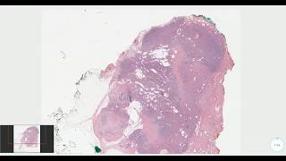 Adenomyoepithelioma Breast  Histopathology [upl. by Wyon352]