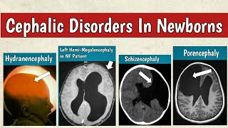 Cephalic Disorders In Newborns  Congenital Brain Malformations Radiology [upl. by Eydie]