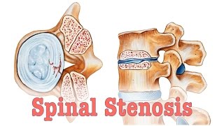 Spinal Stenosis  Surgery vs Chiropractic Care [upl. by Puklich266]