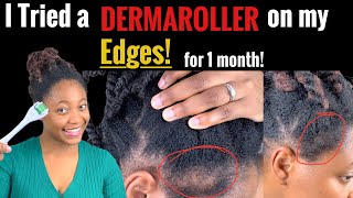 Regrow thin edges using DERMAROLLER on Natural Hair RESULTS  reina [upl. by Stockmon]