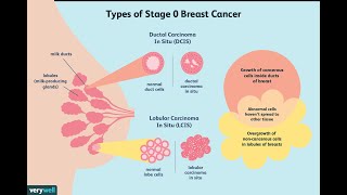 Treatment of Ductal Carcinoma in Situ [upl. by Kamat]